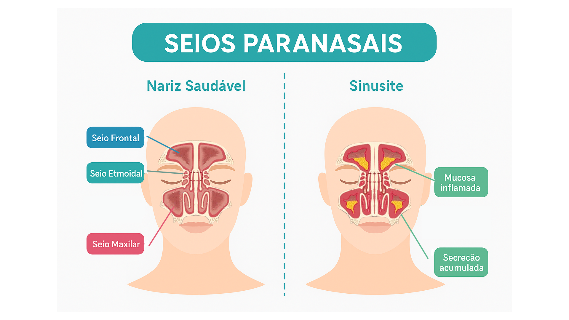 Sinusite crônica: sintomas e tratamento eficaz